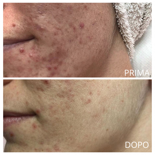 Acne prima e dopo