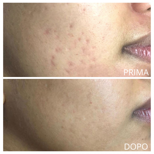 Cicatrici da acne prima e dopo