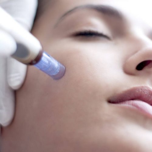 Bern-Microneedling-1024x682