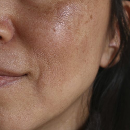 Before and after facial treatment concept. Face with melasma and brown spots and open pores.