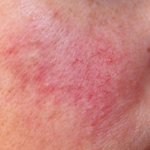 rosacea